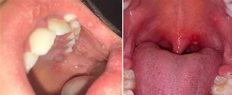 La herpangina, cuando dolorosas úlceras bucales pueden llevar a la deshidratación