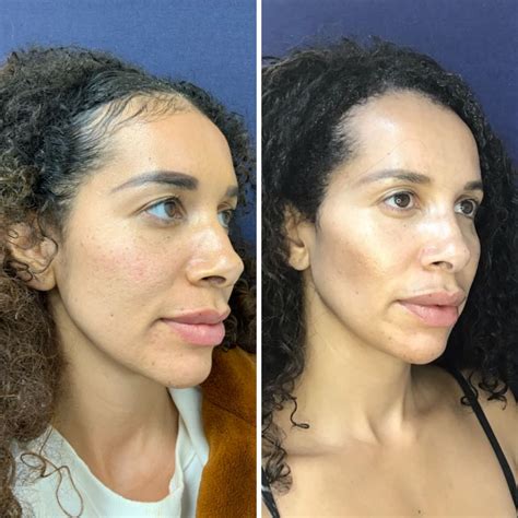 Non Surgical Face Lift Houston at Dorothy Hood blog