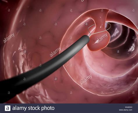Colon Polyp Stock Photos & Colon Polyp Stock Images - Alamy