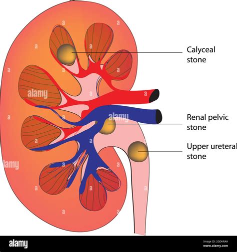 Detailed diagram of kidney stone, Labeled anatomy of human kidney stone ...
