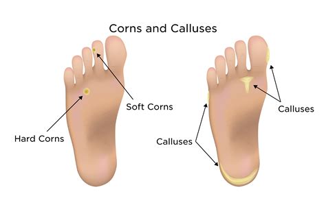 Corn Under Skin On Foot Deals | emergencydentistry.com