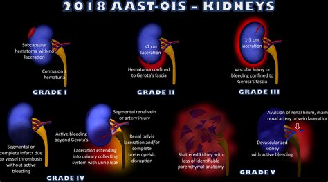 Grading Abdominal Trauma: Changes in and Implications of the Revised ...