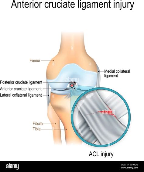 Anterior cruciate ligament diagram Stock Vector Images - Alamy