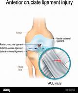 Anterior cruciate ligament diagram Stock Vector Images - Alamy