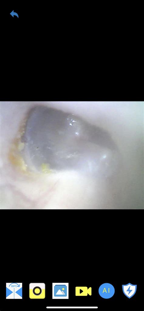 Eustachian Tube Problems
