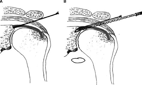 Single-Portal SLAP Lesion Repair - Arthroscopy