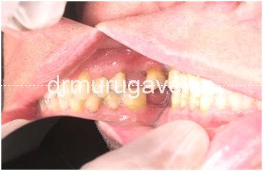 » Multiple teeth replacement with basal implants