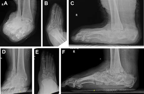 Treatment of Ankle and Hindfoot Charcot Arthropathy - Foot and Ankle Clinics