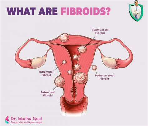 Uterine Fibroids: Essential Information for Every Woman - Dr. Madhu Goel