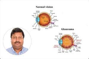 LVPEI doctors discover New Genes that result in childhood glaucoma