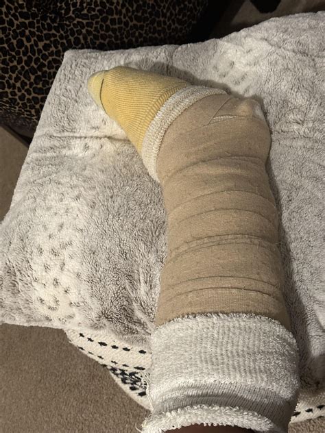 High ankle sprain, torn deltoid, possible break in the fibula : r ...