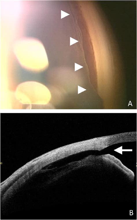 Angle Recession 的图像结果