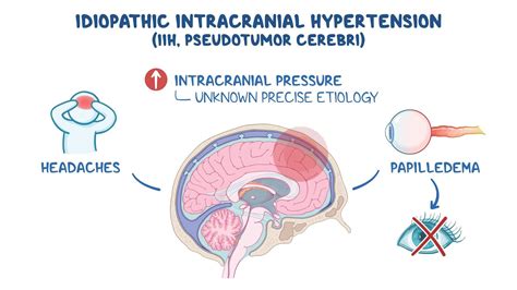 Video: Idiopathic intracranial hypertension: Clinical sciences