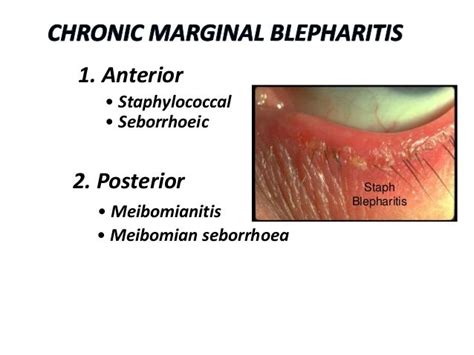 Bildergebnis für blepharitis therapie