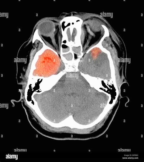 Hematoma subdural hi-res stock photography and images - Alamy