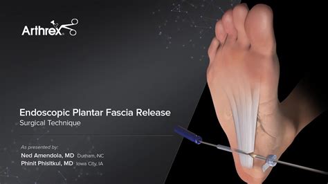 Arthrex - Endoscopic Plantar Fascia Release