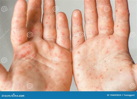 Enterovirus Leg Arm Mouth Rash on the Body of a Child Cocksackie Virus ...