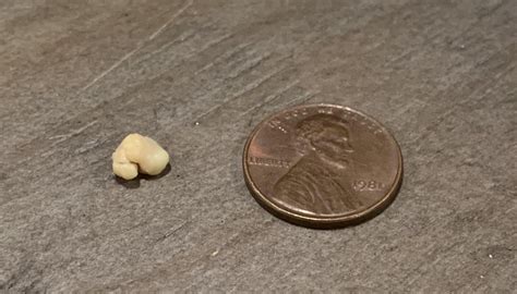 severe tonsil stones. gettting tonsils removed soon. : r/tonsilstones