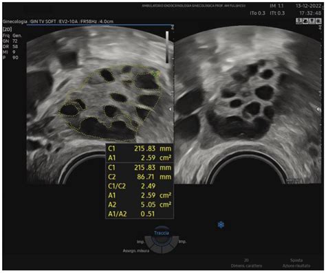 Ultrasound Assessment in Polycystic Ovary Syndrome Diagnosis: From Origins to Future ...