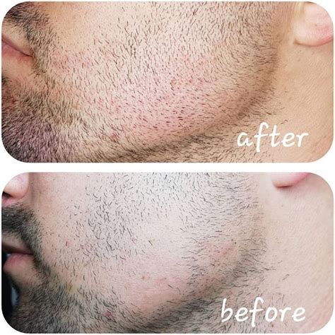 Image result for Microblading Beard