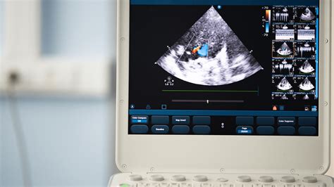 Mitral Valve Regurgitation: Symptoms, Causes & Treatment – Hope For Hearts