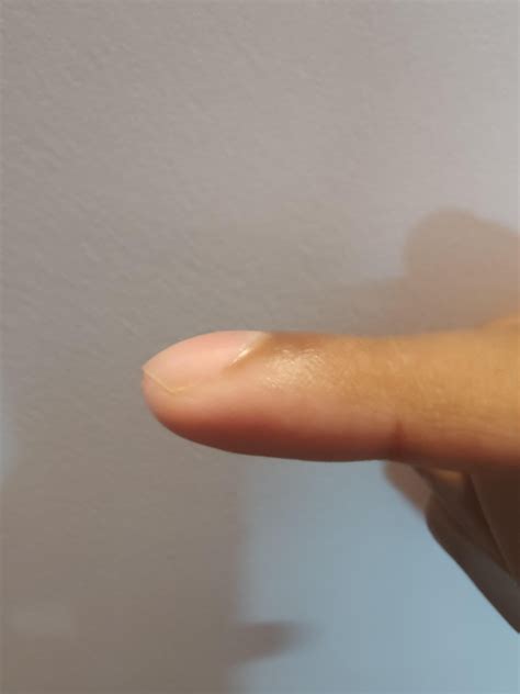 clubbing fingers?. i am 18M. i have noticed my fingers are mildly ...