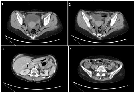 Uroperitoneum as a Complication of Laparoscopic Cholecystectomy: A Case ...