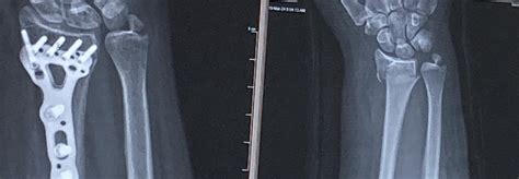 Image result for Distal Radius Fracture Recovery