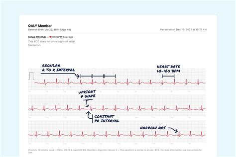 Sinus Rhythm Vs. Ectopic Atrial Rhythm on Your Watch ECG | Qaly