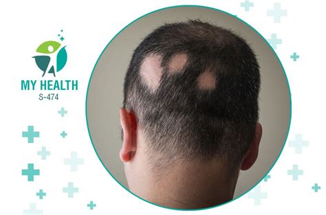 Image result for Alopecia Pronunciation Guide