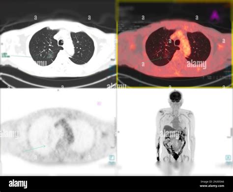 Positron emission tomography (PET) CT scan uses a radioactive drug ...
