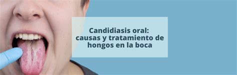 Candidiasis oral: causas y tratamiento de hongos en la boca - Clínica
