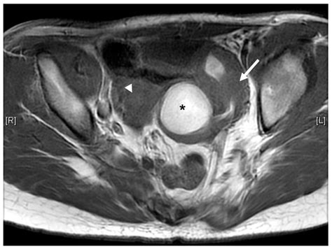 Hydrometrocolpos in Infants: Etiologies and Clinical Presentations