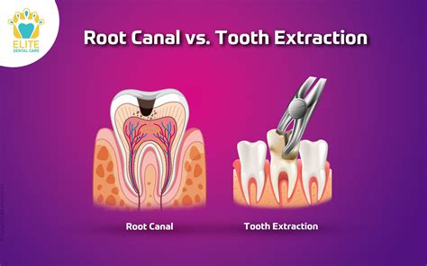 Difficult Tooth Root Extraction 的图像结果
