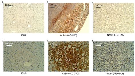 Liver Biopsy Hydroxyproline Content Is a Diagnostic for Hepatocellular ...