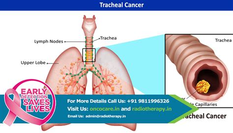 Doctor for Cancer in Delhi, India, Radiation Treatment for Cancer in India.