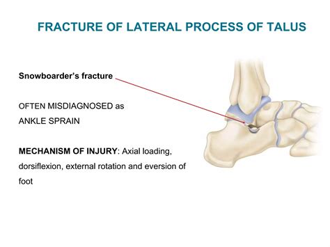 Talus fracture treatment algorithm | PPTX