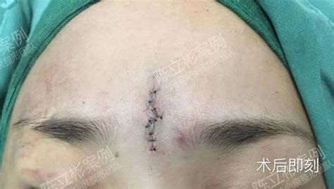 面部疤痕術後1年複診記錄 - 每日頭條