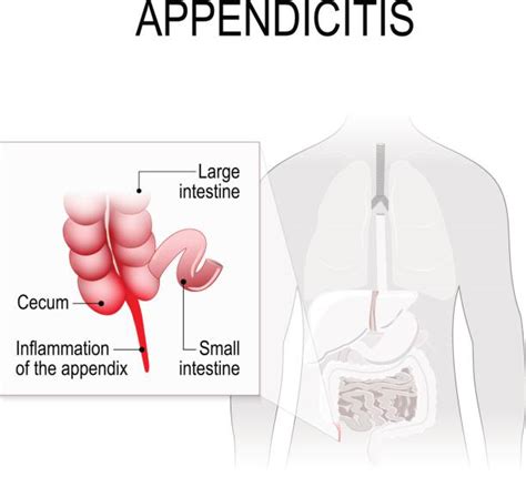 Image result for Appendix Example Website