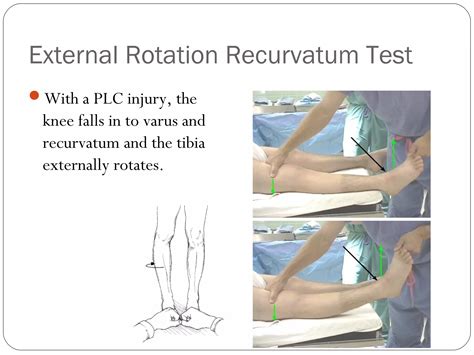 Posterolateral corner injuries of knee joint | PPT