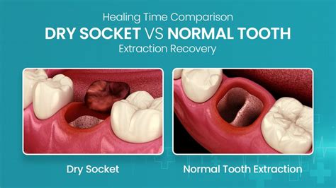 Image result for Healed Tooth Extraction