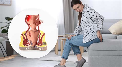 Laser Removal of Pilonidal Sinus (Coccygeal Cyst) with SiLaC – Safe and Effective Treatment