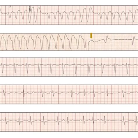 Image result for Synchronized Cardioversion Rhythm Strip