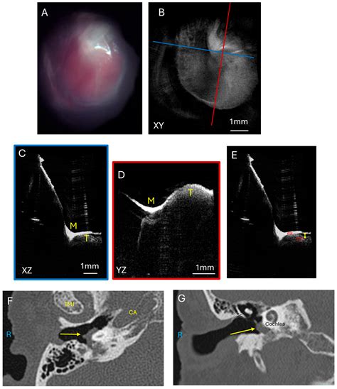 Optical Coherence Tomography Imaging and Angiography of Skull Base ...