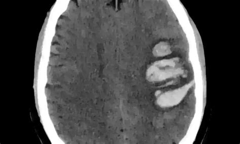 SIGNALS score for in-hospital Neurological deterioration in ...