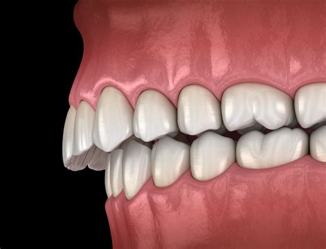 Fixing Buck Teeth (Overbites) - With & Without Braces | CAP City Dental
