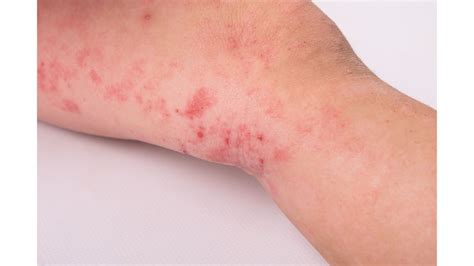 Stage 0 Cancer: 5 Pre-Cancer Symptoms To Never Ignore In Your Early 20s ...