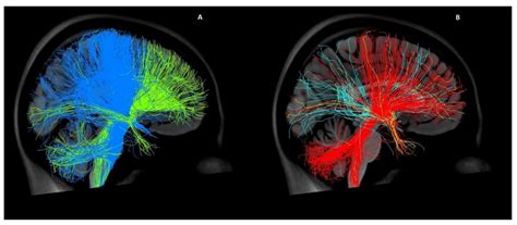 Connectivity Patterns of Deep Brain Stimulation Targets in Patients ...