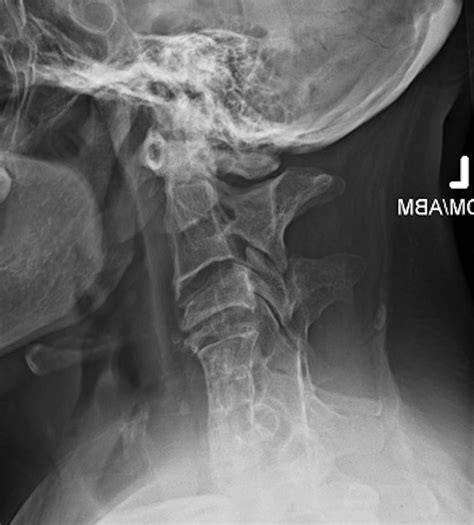 Klippel-Feil Syndrome Essentials, Part 2: Advanced Imaging Techniques and Diagnostic Strategies ...
