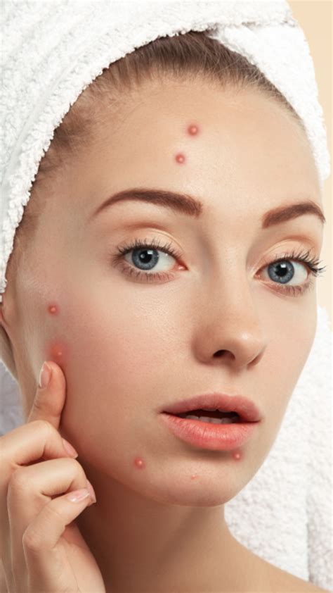 Image result for Exploding Face Zits